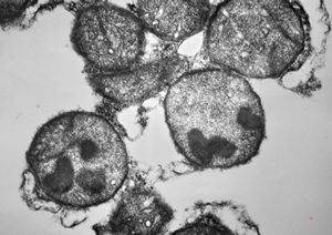 M,2y. | dense mitochondrial inclusions - clinically susp. Zellweger syndrome